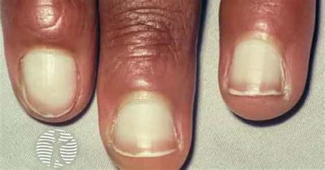 define leukonychia|Leukonychia and Other Nail Discoloration: An Overview.